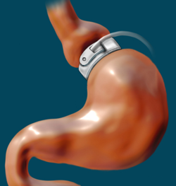 How Does A Gastric Band Work?