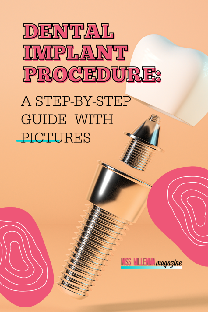 Dental Implant Procedure: A Step-by-Step Guide with Pictures